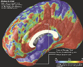  ... drugs the shaded areas of professional brain imaging depict damage not